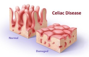 Gluten Sensitivity & Celiac Disease