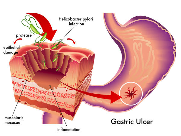 About H.Pylori